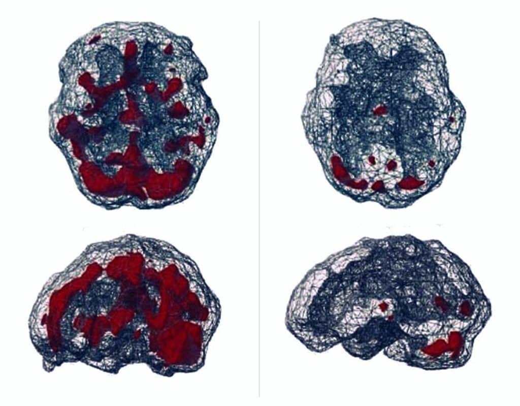 Before and after sessions of EMDR therapy - affects on the brain